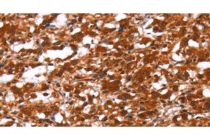 Immunohistochemistry of paraffin-embedded Human thyroid cancer using FUT1 Polyclonal Antibody at dilution of 1:30 (FUT1 antibody)