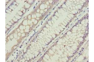 Immunohistochemistry of paraffin-embedded human colon cancer using ABIN7153839 at dilution of 1:100