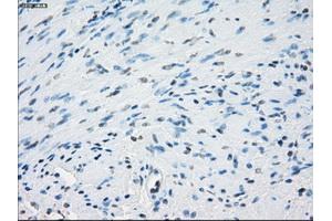 Immunohistochemical staining of paraffin-embedded Adenocarcinoma of colon tissue using anti-AURKCmouse monoclonal antibody. (Aurora Kinase C antibody)