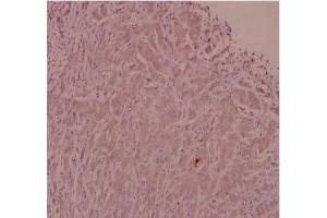 Immunohistochemistry analysis of ADM Antibody in paraffin-embedded human breast carcinoma tissue at 1/100. (Adrenomedullin antibody)