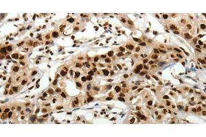 Immunohistochemistry of paraffin-embedded Human lung cancer tissue using SCN1A Polyclonal Antibody at dilution 1:40 (SCN1A antibody)