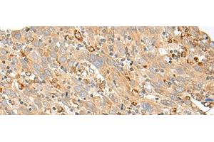Immunohistochemistry of paraffin-embedded Human cervical cancer tissue using SLC5A1 Polyclonal Antibody at dilution of 1:80(x200) (SLC5A1 antibody)