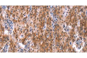 Immunohistochemistry of paraffin-embedded Human gastric cancer using GH1 Polyclonal Antibody at dilution of 1:40 (Growth Hormone 1 antibody)