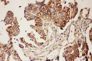 Anti-CNTF Picoband antibody,  IHC(P): Human Intestinal Cancer Tissue (CNTF antibody  (AA 2-200))