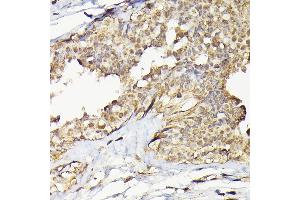 Immunohistochemistry of paraffin-embedded human breast cancer using T Rabbit pAb (ABIN6129486, ABIN6148851, ABIN6148852 and ABIN6223435) at dilution of 1:200 (40x lens). (TARBP2 antibody  (AA 1-366))