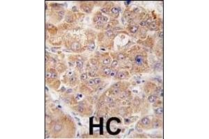 Formalin-fixed and paraffin-embedded human hepatocarcinoma tissue reacted with hUVRAG (N-term ), which was peroxidase-conjugated to the secondary antibody, followed by DAB staining. (UVRAG antibody  (AA 120-152))