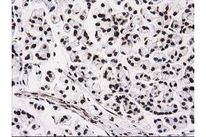 Immunohistochemical staining of paraffin-embedded Adenocarcinoma of Human colon tissue using anti-ATP6V1F mouse monoclonal antibody. (ATP6V1F antibody)