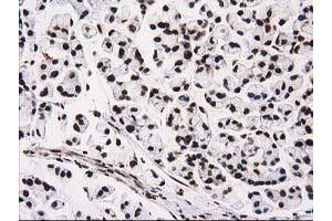 Immunohistochemical staining of paraffin-embedded Adenocarcinoma of Human colon tissue using anti-ATP6V1F mouse monoclonal antibody.