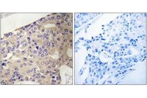 Immunohistochemistry analysis of paraffin-embedded human breast carcinoma tissue, using PEX10 Antibody. (PEX10 antibody  (AA 183-232))