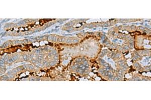 Immunohistochemistry of paraffin-embedded Human thyroid cancer tissue using ENKD1 Polyclonal Antibody at dilution of 1:75(x200) (ENKD1 antibody)