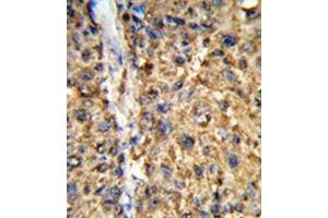 Immunohistochemistry in Formalin-fixed and paraffin-embedded human hepatocarcinoma reacted with GSTA2 / GST2 Antibody (N-term) followed which was peroxidase-conjugated to the secondary antibody, followed by DAB staining. (GSTa2 antibody  (N-Term))