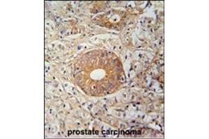 Immunohistochemistry analysis in Formalin Fixed, Paraffin Embedded Human prostate carcinoma stained with SLC35E2 Antibody (N-term) followed by peroxidase conjugation of the secondary antibody and DAB staining. (SLC35E2 antibody  (N-Term))