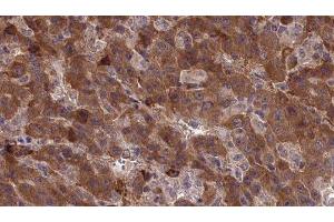 ABIN6277338 at 1/100 staining Human liver cancer tissue by IHC-P. (CDH23 antibody  (N-Term))