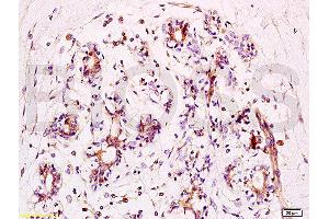 Formalin-fixed and human breast carcinoma tissue labeled with Anti-phospho-BACH1/BRIP1(Ser990) Polyclonal Antibody, Unconjugated  at 1:200 followed by conjugation to the secondary antibody and DAB staining (BRIP1 antibody  (pSer990))