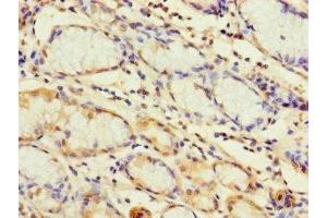 Immunohistochemistry of paraffin-embedded human gastric cancer using ABIN7172261 at dilution of 1:100 (TLR1 antibody  (AA 25-580))
