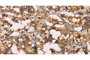 Immunohistochemistry of paraffin-embedded Human thyroid cancer using SENP1 Polyclonal Antibody at dilution of 1:40 (SENP1 antibody)