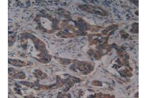 IHC-P analysis of Human Breast Cancer Tissue, with DAB staining. (KIT antibody  (AA 321-520))