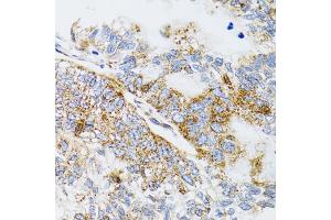 Immunohistochemistry of paraffin-embedded human gastric cancer using PDYN antibody.
