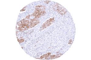 Pulmonary adenocarcinoma with moderate to strong PSAT1 staining of most tumor cells