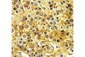 IHC analysis of FFPE human hepatocarcinoma with Src antibody (Src antibody  (AA 397-424))