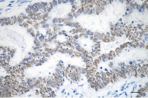 Immunohistochemistry was performed on paraffin-embedded human sigmoid colon carcinoma using SOX9 antibody (ABIN7800973), 1:200). (Recombinant SRY-Box Transcription Factor 9 antibody)