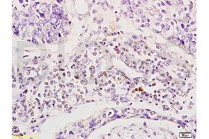 Formalin-fixed and human esophageal cancer tissue labeled with Anti-Phospho-CD19(Tyr531) Polyclonal Antibody, Unconjugated (ABIN683623) at 1:200 followed by conjugation to the secondary antibody and DAB staining (CD19 antibody  (pTyr531))