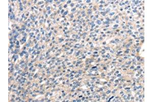 The image on the left is immunohistochemistry of paraffin-embedded Human breast cancer tissue using ABIN7127958(CENPM Antibody) at dilution 1/30, on the right is treated with fusion protein. (CENPM antibody)