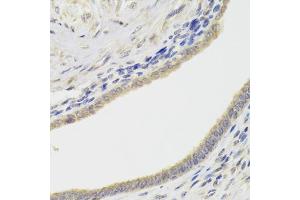 Immunohistochemistry of paraffin-embedded human adenomyosis using HDAC4 Antibody (ABIN5975864) at dilution of 1/100 (40x lens).