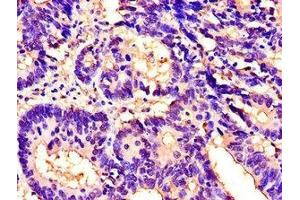 Immunohistochemistry of paraffin-embedded human colon cancer using ABIN7156464 at dilution of 1:100 (CD11b antibody  (AA 46-150))
