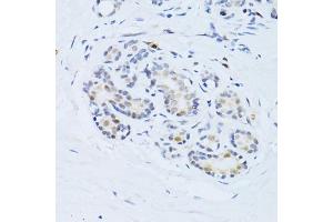 Immunohistochemistry of paraffin-embedded human breast using CDKN1A antibody (ABIN4903234) at dilution of 1:100 (40x lens). (p21 antibody)