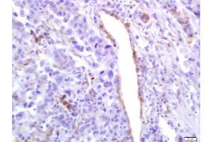 Formalin-fixed and paraffin embedded human lung carcinoma labeled with Anti-Phospho-PLK1 (Ser137) Polyclonal Antibody, Unconjugated (ABIN744938) at 1:200 followed by conjugation to the secondary antibody and DAB staining (PLK1 antibody  (pSer137))