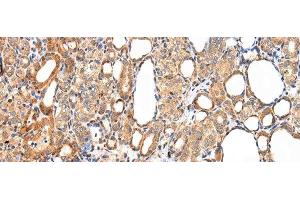 Immunohistochemistry of paraffin-embedded Human thyroid cancer tissue using AQP7 Polyclonal Antibody at dilution 1:40 (Aquaporin 7 antibody)