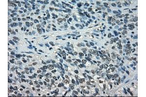 Immunohistochemical staining of paraffin-embedded Carcinoma of thyroid tissue using anti-STAT1mouse monoclonal antibody. (STAT1 antibody)