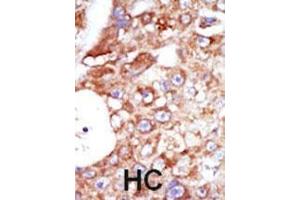 Formalin-fixed and paraffin-embedded human cancer tissue reacted with the primary antibody, which was peroxidase-conjugated to the secondary antibody, followed by AEC staining. (SYK antibody  (C-Term))