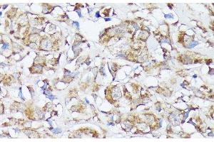 Immunohistochemistry of paraffin-embedded Human mammary cancer using MTHFD2 Polyclonal Antibody at dilution of 1:100 (40x lens). (MTHFD2 antibody)