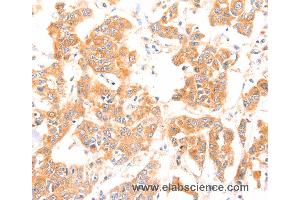 Immunohistochemistry of Human breast cancer using PRDX2 Polyclonal Antibody at dilution of 1:80 (Peroxiredoxin 2 antibody)
