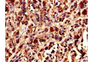 Immunohistochemistry of paraffin-embedded human melanoma using ABIN7175897 at dilution of 1:100 (XRCC5 antibody  (AA 251-455))