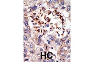 Formalin-fixed and paraffin-embedded human cancer tissue reacted with the primary antibody, which was peroxidase-conjugated to the secondary antibody, followed by DAB staining. (CBX8 antibody  (C-Term))