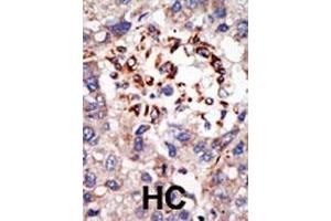 Formalin-fixed and paraffin-embedded human cancer tissue reacted with the primary antibody, which was peroxidase-conjugated to the secondary antibody, followed by DAB staining. (CBX8 antibody  (C-Term))