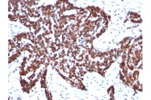 Formalin-fixed, paraffin-embedded human Ovarian Carcinoma stained with Cyclin B1 Mouse Monoclonal Antibody (CCNB1/1098). (Cyclin B1 antibody)