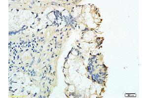 Formalin-fixed and human rectal carcinoma tissue labeled with Anti-B7-H1/PD-L1/CD274 Polyclonal Antibody, Unconjugated (ABIN737706) at 1:200 followed by conjugation to the secondary antibody and DAB staining (PD-L1 antibody  (AA 201-290))