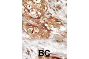 Formalin-fixed and paraffin-embedded human cancer tissue reacted with MAP3K14 polyclonal antibody  , which was peroxidase-conjugated to the secondary antibody, followed by AEC staining. (MAP3K14 antibody  (AA 126-155))