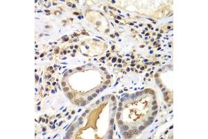 Immunohistochemistry of paraffin-embedded human gastric cancer using PSME2 antibody. (PSME2 antibody  (AA 1-239))