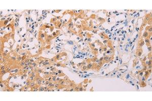 Immunohistochemistry of paraffin-embedded Human lung cancer tissue using ADHFE1 Polyclonal Antibody at dilution 1:30 (ADHFE1 antibody)
