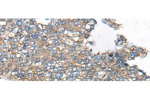 Immunohistochemistry of paraffin-embedded Human liver cancer tissue using CDC42BPA Polyclonal Antibody at dilution of 1:60(x200) (CDC42BPA antibody)