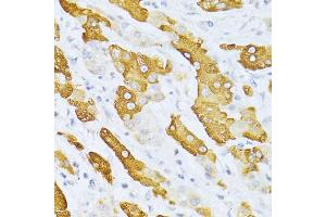 Immunohistochemistry of paraffin-embedded human liver cancer using CYP2E1 antibody (ABIN5971187) at dilution of 1/100 (40x lens). (CYP2E1 antibody)