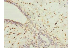Immunohistochemistry of paraffin-embedded human breast cancer using ABIN7164641 at dilution of 1:100 (GLT25D2 antibody  (AA 351-626))