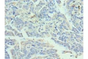 Immunohistochemistry of paraffin-embedded human lung cancer using ABIN7155475 at dilution of 1:100 (EZH1 antibody  (AA 160-280))