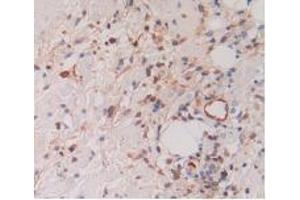 IHC-P analysis of Human Skin Cancer Tissue, with DAB staining. (Cytohesin 1 antibody  (AA 1-398))