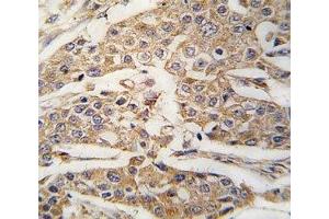 IHC analysis of FFPE human breast carcinoma tissue stained with PKM2 antibody (PKM2 antibody  (AA 460-489))
